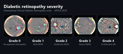 APTOS 2019 Blindness Detection featured image