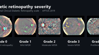 APTOS 2019 Blindness Detection featured image